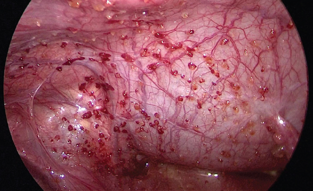 Intra-operative photograph obtained during diagnostic laparoscopy showing multiple cystic lesions studding the peritoneal cavity.